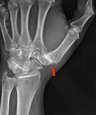 Xray Thumb Arthritis